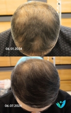 Saç PRP Öncesi Sonrası