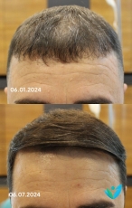 Saç PRP Öncesi Sonrası