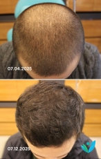Saç PRP Öncesi Sonrası