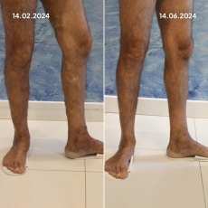 Varis Tedavisi Öncesi Sonrası