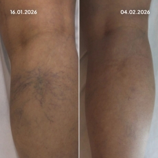 Varis Tedavisi Öncesi Sonrası