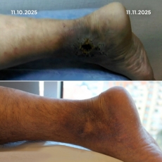 Varis Tedavisi Öncesi Sonrası