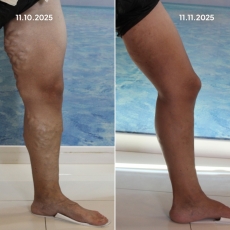 Varis Tedavisi Öncesi Sonrası