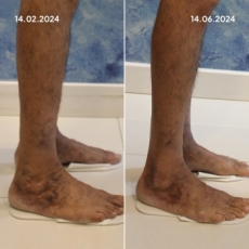 Varis Tedavisi Öncesi Sonrası