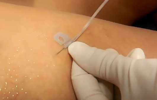 Foam Sclerotherapy for Varicose Veins