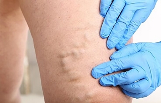 Varicose Vein Symptoms