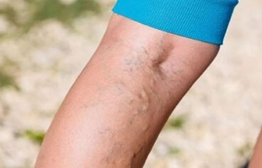 What is Varicose Veins?