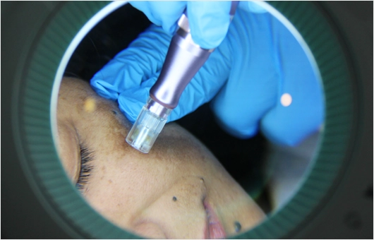 Yüze Eksozom Tedavisi