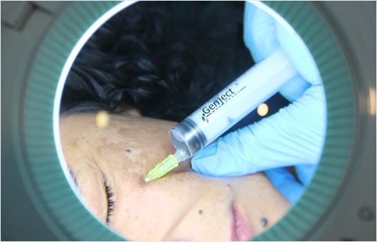 Yüze Eksozom Tedavisi